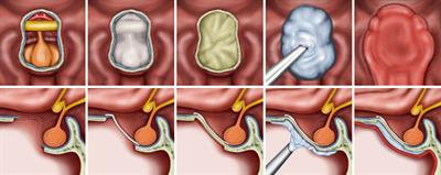 Clinical Impact of Hydroxyapatite on the Outcome of Skull Base Reconstruction for Intraoperative High-Flow CSF Leak: A Propensity Score Matching Analysis